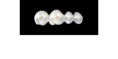 Cod.S2UPPER RIGHT : 15x  posterior solid (not hollow) wax bridges, MEDIUM, (14-17) , with precarved occlusion to Cod.S2LOWER RIGHT,and compatible to Cod.E2UPPER RIGHT (hollow), (14-17)